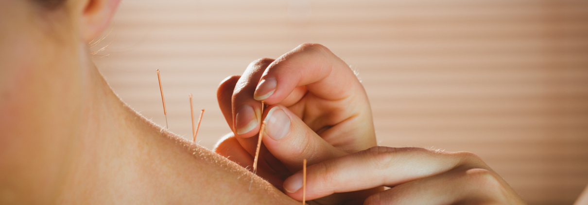 Young woman getting acupuncture treatment in therapy room